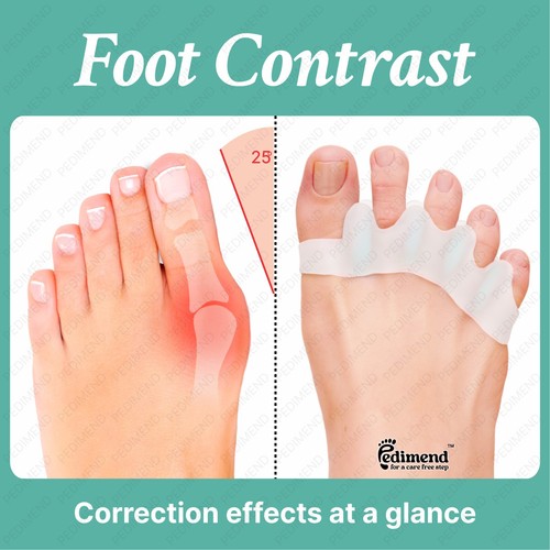 Pedimend gel toe separator - pedimend™,