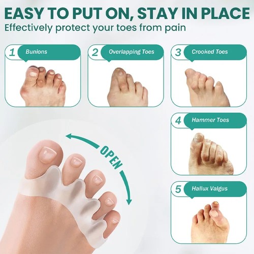 Bunion correction hammer toe - bunion,