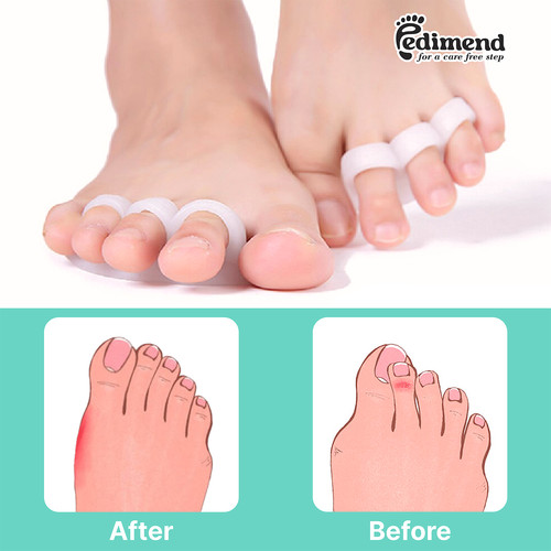 Pedimend silicone gel toe - pedimend™,